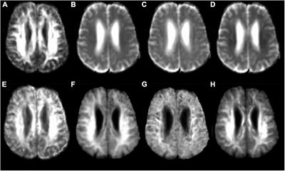 Comparison of brain microstructure alterations on diffusion kurtosis imaging among Alzheimer’s disease, mild cognitive impairment, and cognitively normal individuals